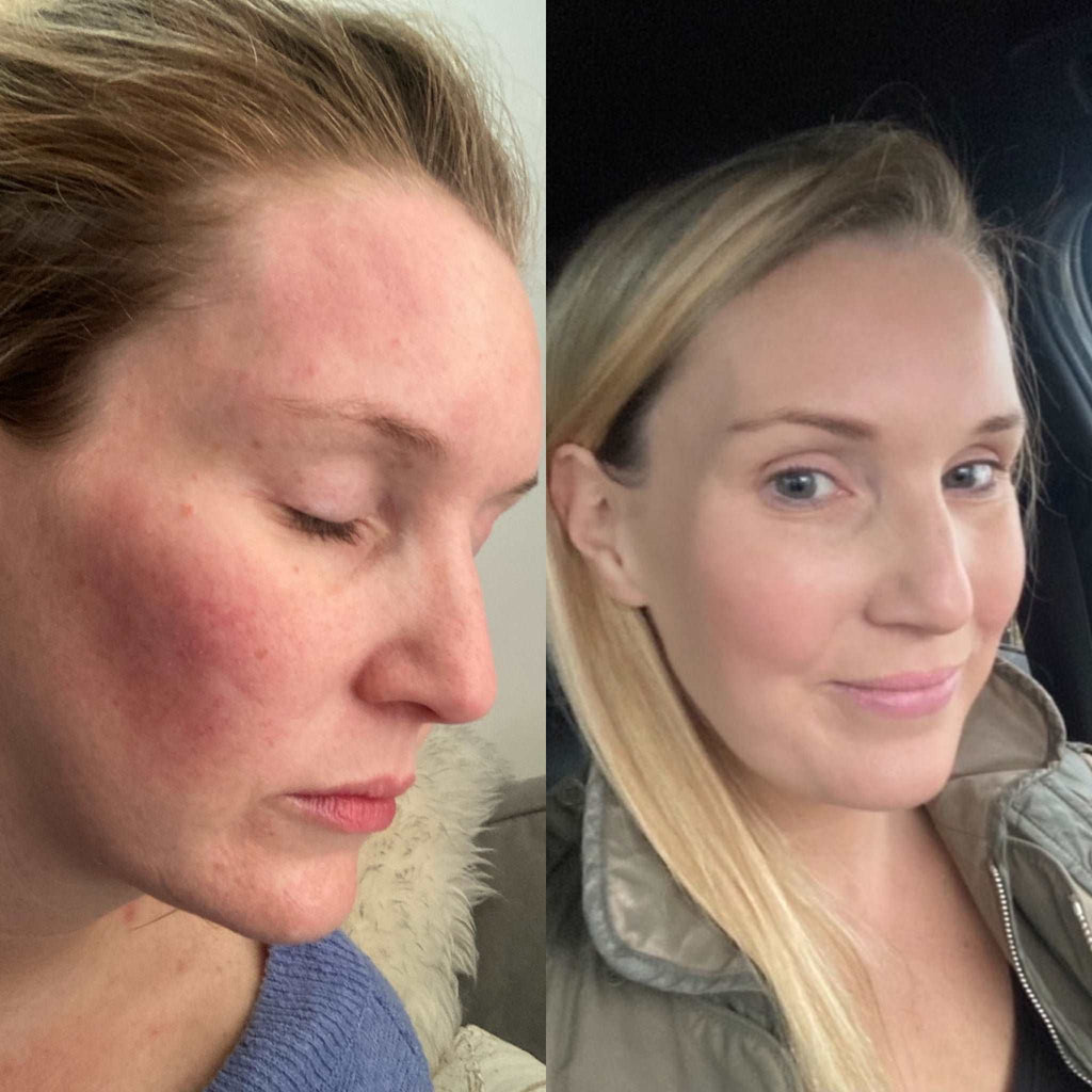 Before and after comparison of a woman's face with visible skin concerns.