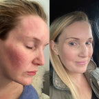 Before and after comparison of a woman's face with visible skin concerns.